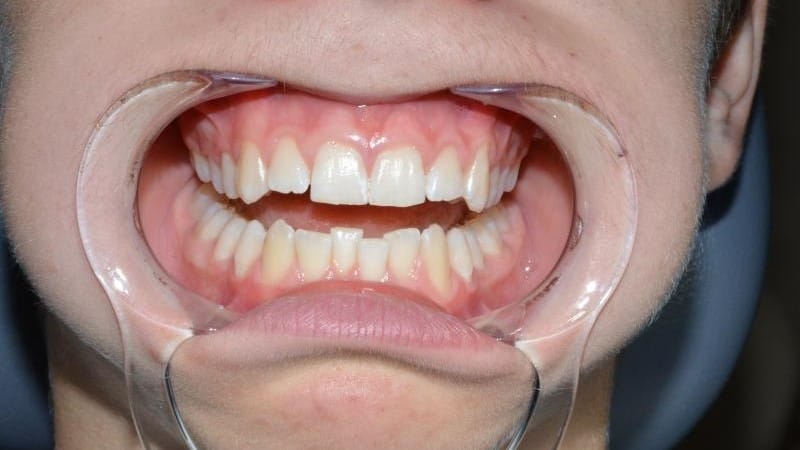 Tymek przed leczeniem