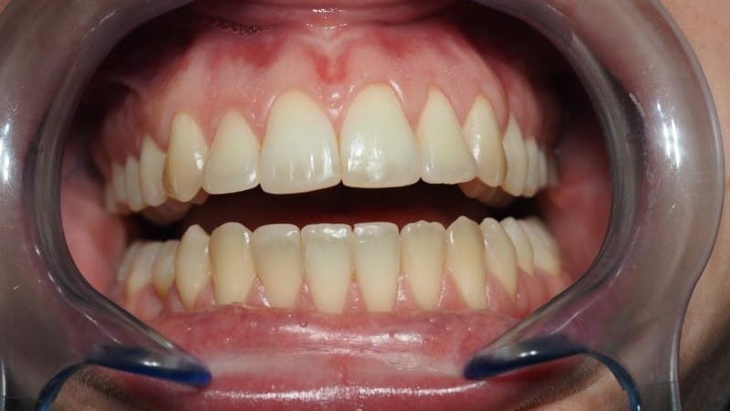 Magdalena po leczeniu