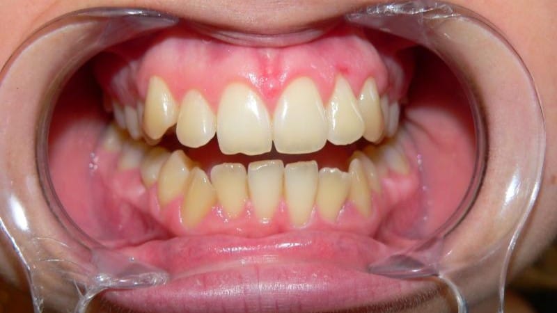 Magdalena przed leczeniem