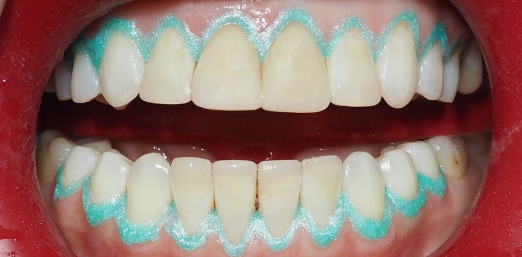 Zdjęcie przedstawia proces wybielania zębów