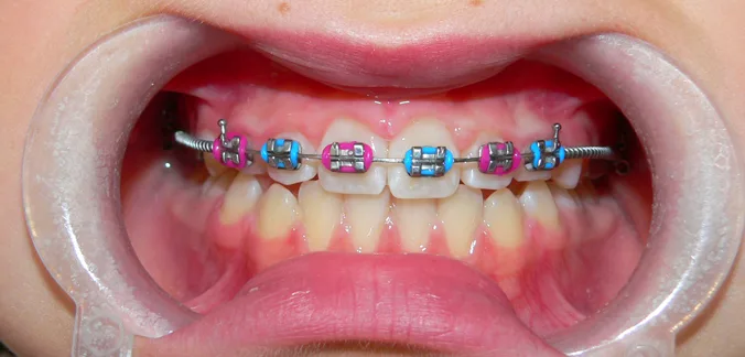 Zdjęcie przedstawia aparat fragmentaryczny na zębach