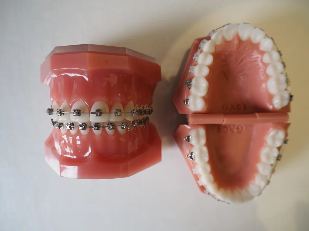 Zdjęcie przedstawia aparat ortodontyczny w systemie Damon