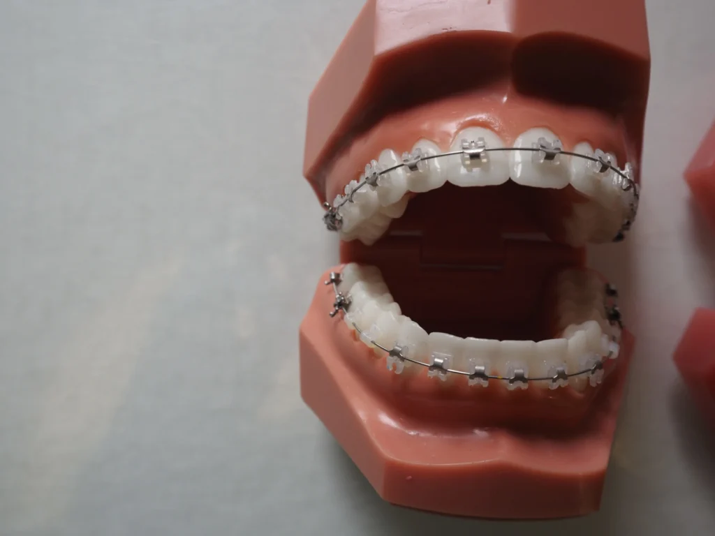 Zdjęcie przedstawia aparat ortodontyczny w systemie In-Ovation